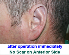 plastic-surgery-prominent-ear 